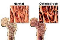 Hogere inname van omega-3 gekoppeld aan lager risico op osteoporose