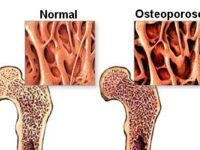 Hogere inname van omega-3 gekoppeld aan lager risico op osteoporose