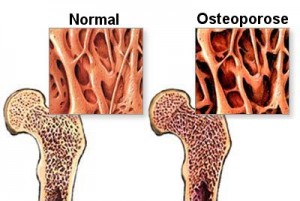 osteoporose