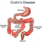 Crohn