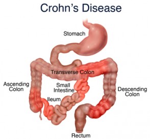 Crohn