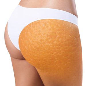 Cellulite