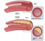 Arteriosclerose