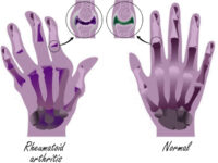 Een voeding die ontstekingen remt, helpt misschien tegen reuma