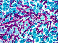 Relatie tussen schimmelinfecties en kanker