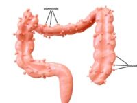 Diverticulose aanpakken met prebiotische vezels en lactoferrine