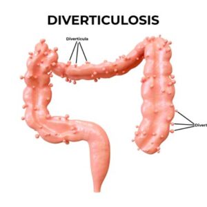 Diverticulosis