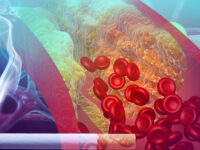 Vitamine K2 en vaatwandverkalking door roken