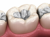 Amalgaamverwijdering verlaagt serum-kwik