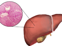 Preventie en reductie van NAFLD