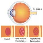 Voorkom_Macular-Degenerationt