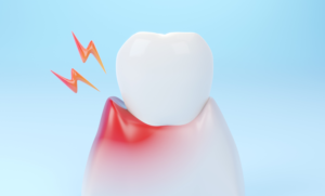 periodontitis