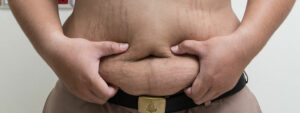 gastric-bypass