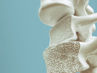 Vitamine K2-spiegel eerder verlaagd bij osteoporose