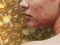 Omega 3-vetzuren verminderen bijwerkingen acnebehandeling