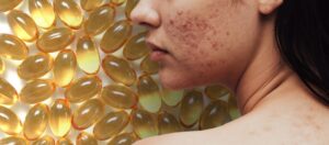 Omega-3-vetzuren-verminderen-bijwerkingen-acnebehandelingen-e1706520255454
