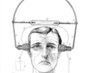 Bij migraine is PEA een alternatief voor ibuprofen