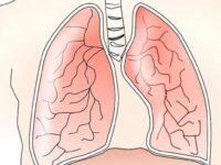 Vitamine C en vitamine E bevorderen herstel na klaplong