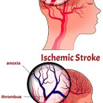 Vitaminensuppletie als beroertepreventie
