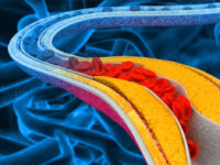 Curcumine vermindert risico op atherosclerose bij diabetes