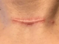 Bang voor littekens? Verminder je inname van omega-6-vetzuren en verhoog die van omega-3