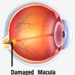 Antioxidanten tegen maculadegeneratie