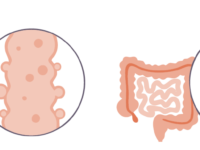 Schade aan het darmslijmvlies gelinkt aan Parkinson?