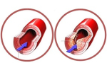 Cardiovasculaire-sterfte-vitamineK2-tekort