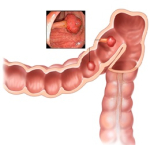 Antioxidanten tegen darmtumoren