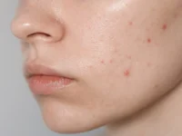 Gezonde voeding vermindert acne
