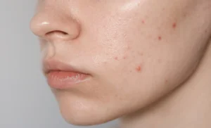 Acne1506-web-aspect-ratio-1500-910.png